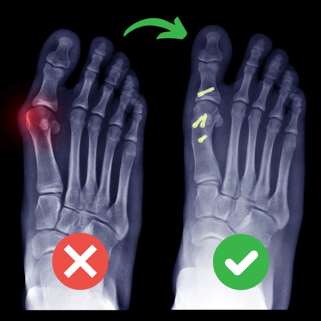 BunionFix™️ - Natural Bunion Corrector