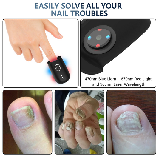 Laser Heal Toenail Fungus Removal Laser